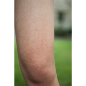 Bumpy Skin on the Arm: What Can You Do?