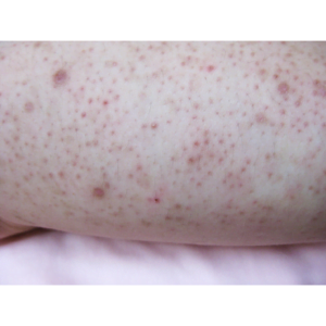 Bumpy Skin on the Arm: What Can You Do?