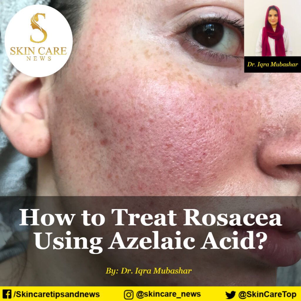 How to Treat Rosacea Using Azelaic Acid? Skincare News
