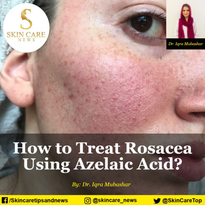 How to Treat Rosacea Using Azelaic Acid?