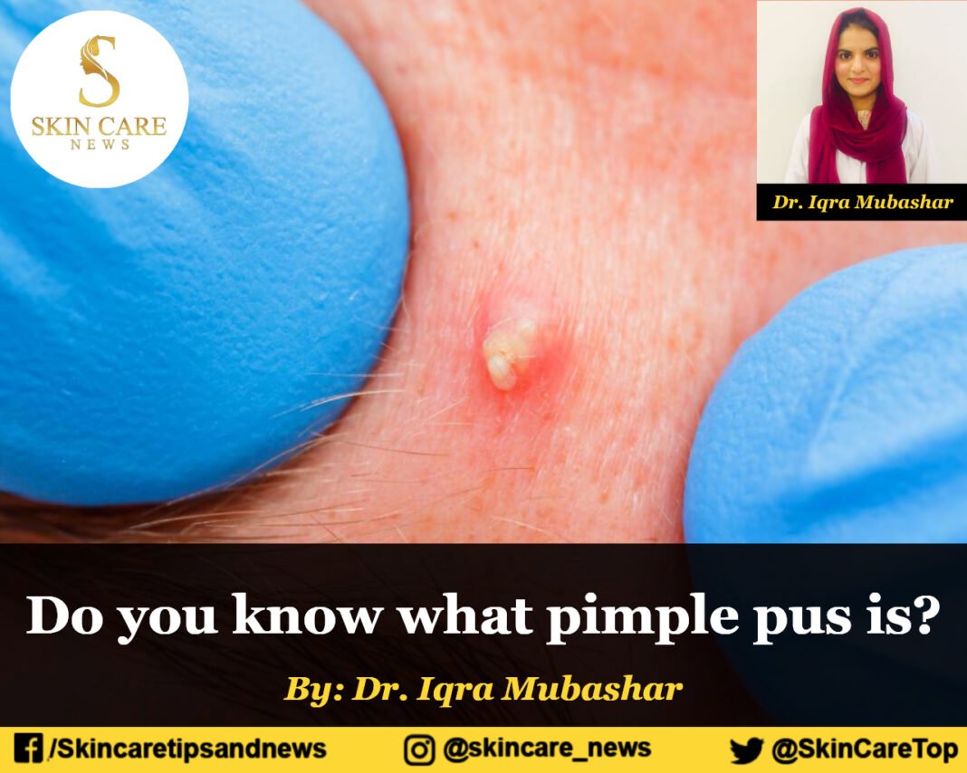 remove-pimple-overnight-pimple-patches-remove-pus-pimple-acne