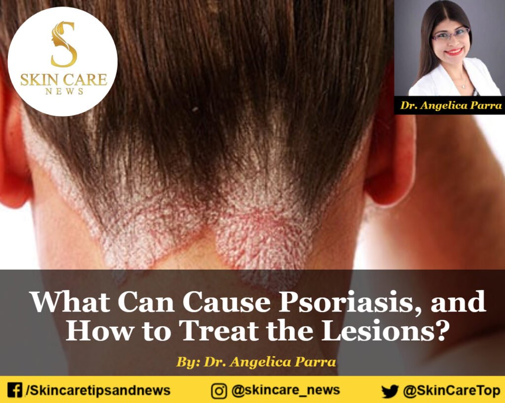 What can cause psoriasis, and how to treat the lesions?