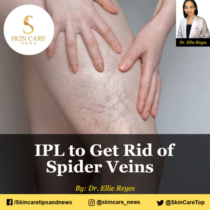 IPL to Get Rid of Spider Veins