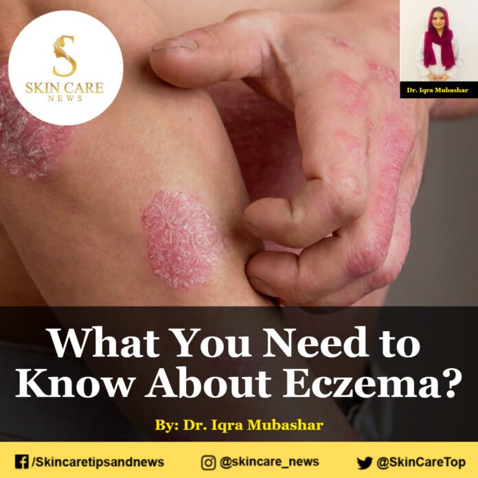 What You Need to Know About Eczema?