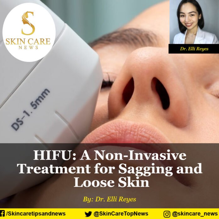 HIFU: A Non-Invasive Treatment for Sagging and Loose Skin