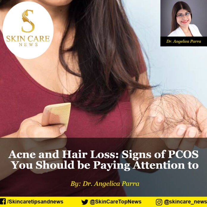 Acne and Hair Loss: Signs of PCOS You Should be Paying Attention to