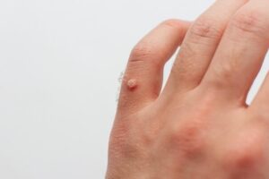 Warts: Learn How to Recognize the Alarm Signs and Treat Them