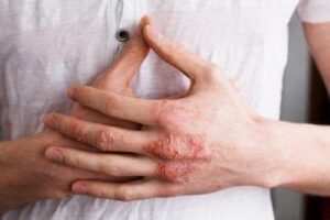 What You Need to Know About Eczema?