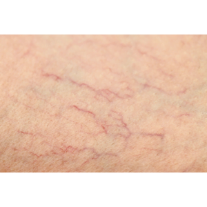  IPL to Get Rid of Spider Veins 