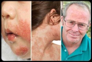 What You Need to Know About Eczema?