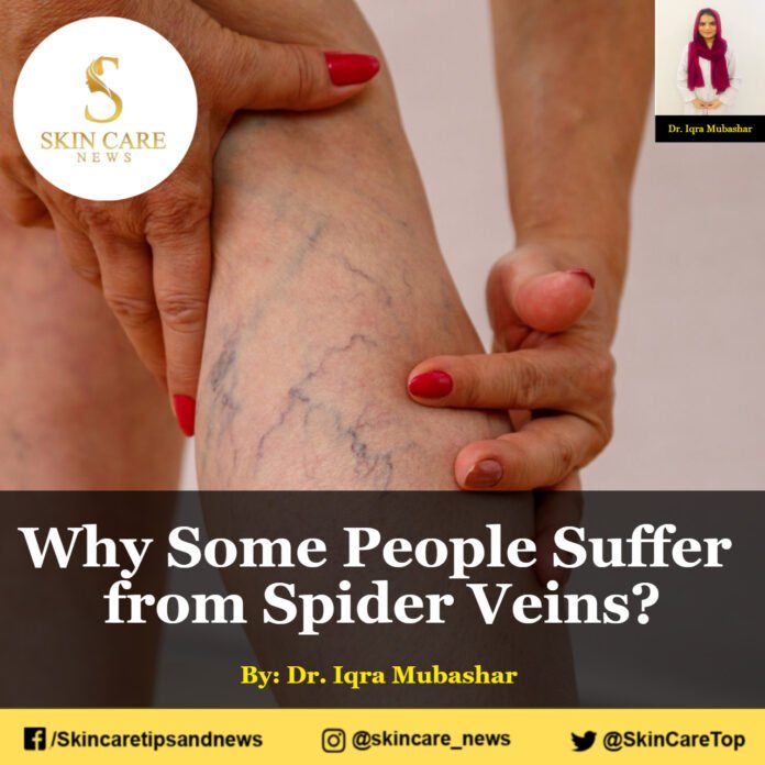 Why Some People Suffer from Spider Veins?
