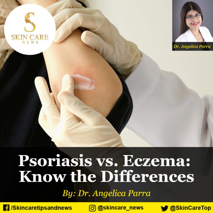Psoriasis vs. Eczema: Know the Differences