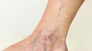 Why Some People Suffer from Spider Veins?