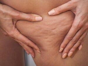 What Is Cellulite and Why You Get It?