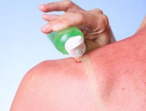 Why Is Sunburn Itch Called Hell's Itch and How to Get Rid of It?