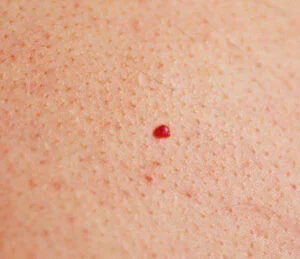 What Are the Red Moles On Your Skin?
