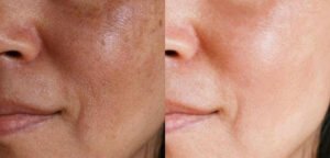 Why Do You Get Age Spots?