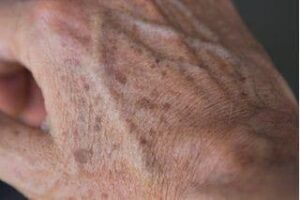 Why Do You Get Age Spots?