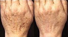 Why Do You Get Age Spots?