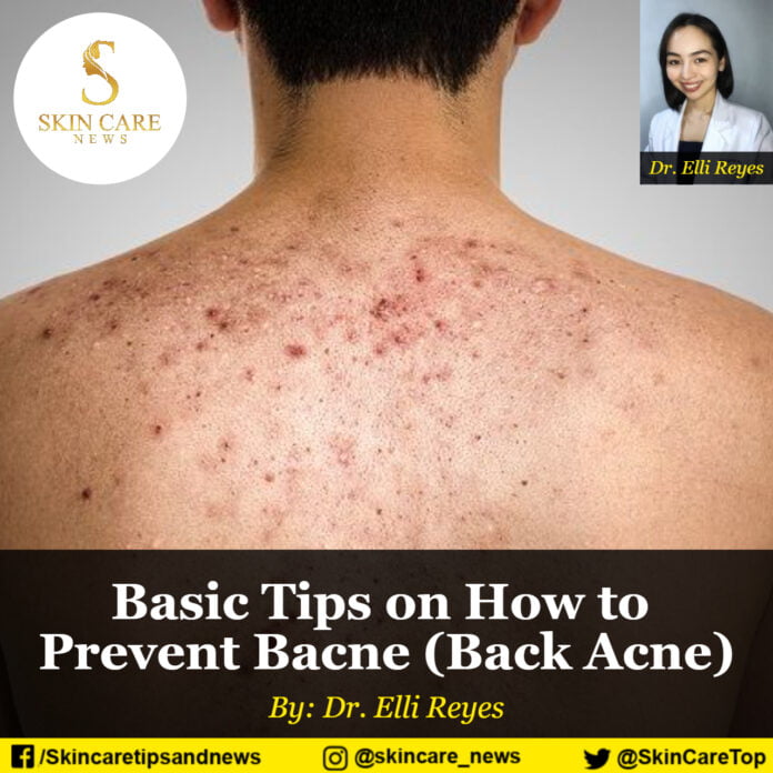 Basic Tips on How to Prevent Bacne (Back Acne)