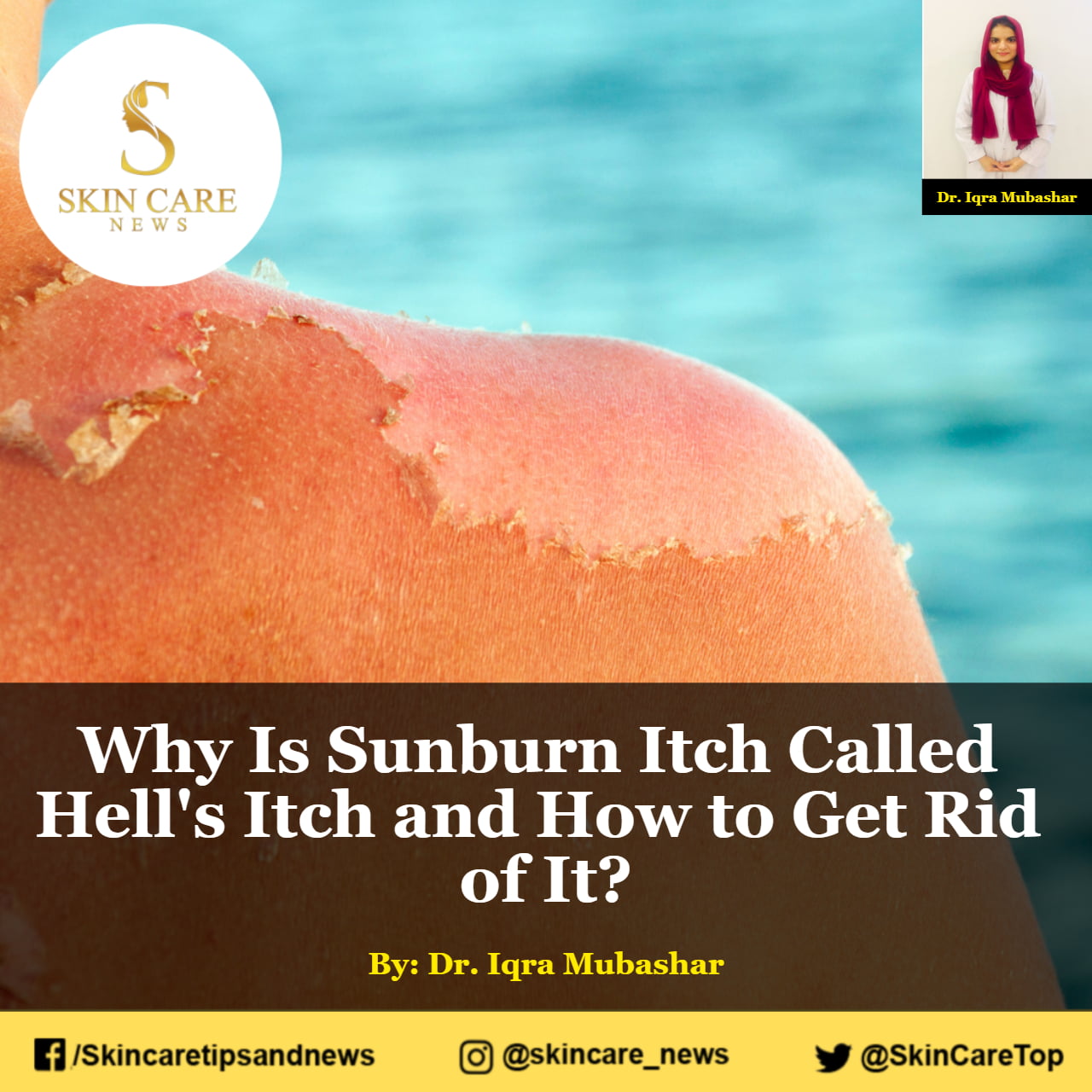 Why Is Sunburn Itch Called Hells Itch And How To Get Rid Of It