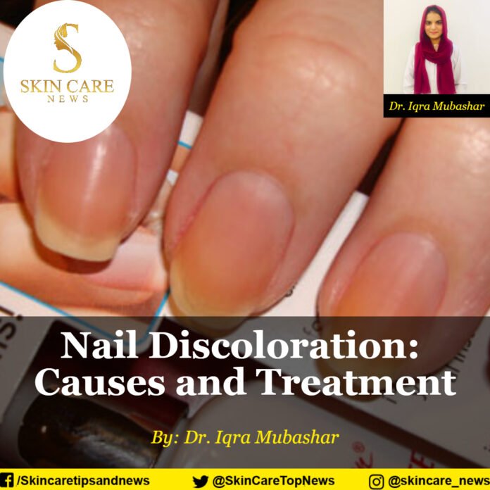 Nail Discoloration: Causes and Treatment