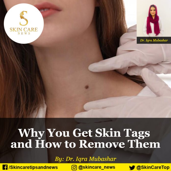 Why You Get Skin Tags and How to Remove Them