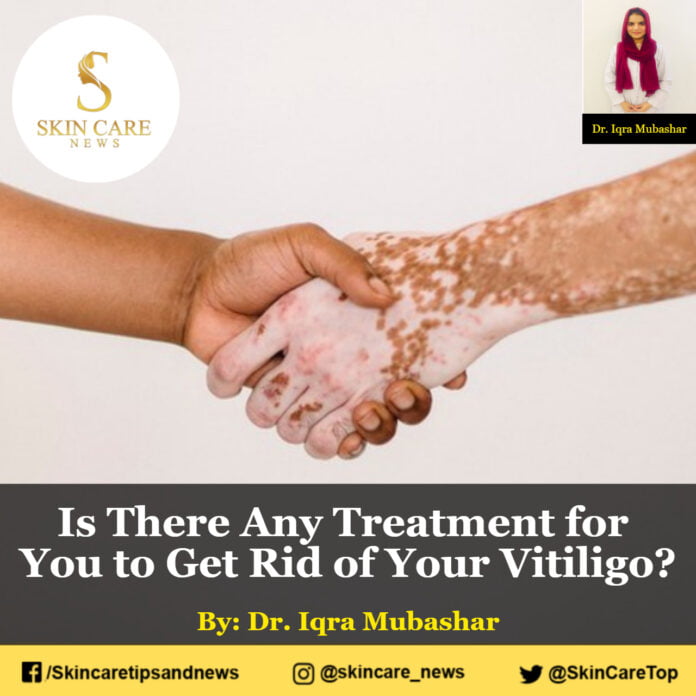 Is There Any Treatment for You to Get Rid of Your Vitiligo?