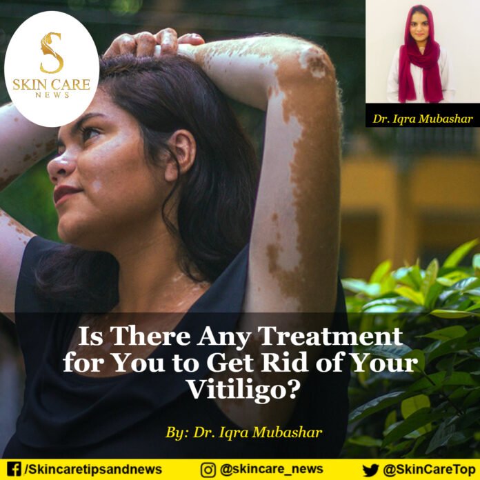 Is There Any Treatment for You to Get Rid of Your Vitiligo?
