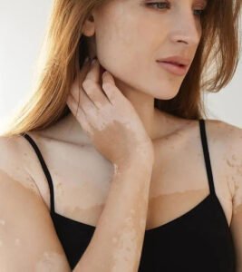 Is There Any Treatment for You to Get Rid of Your Vitiligo?   