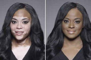 Is There Any Treatment for You to Get Rid of Your Vitiligo?   
