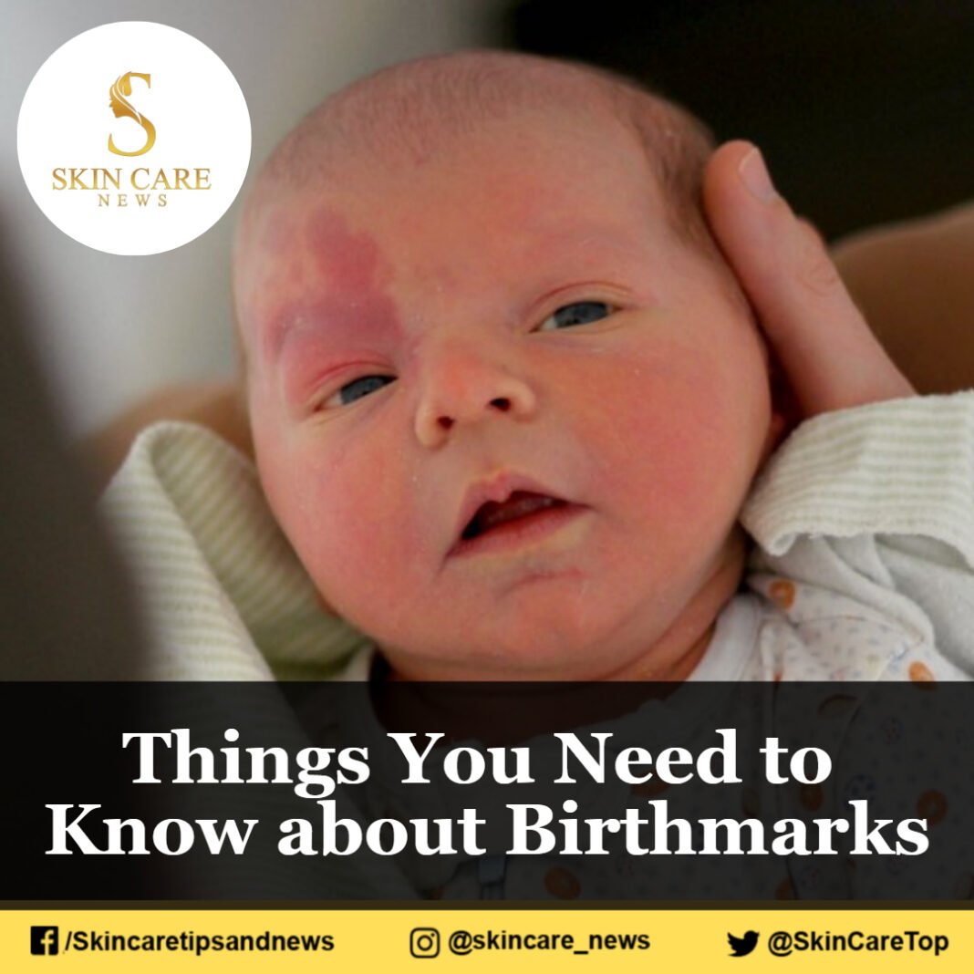 Things You Need To Know About Birthmarks