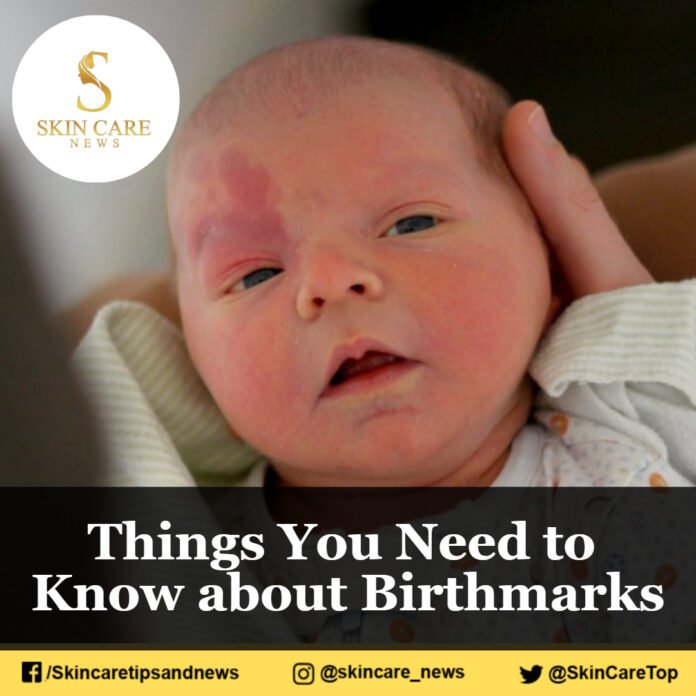 Things You Need to Know about Birthmarks