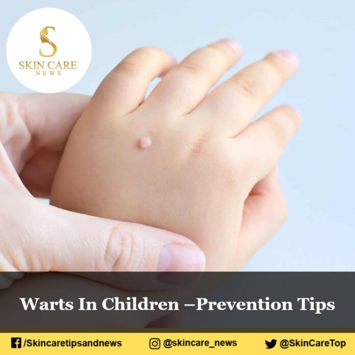 Warts In Children –Prevention Tips