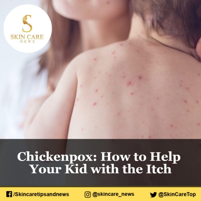 Chickenpox: How to Help Your Kid with the Itch