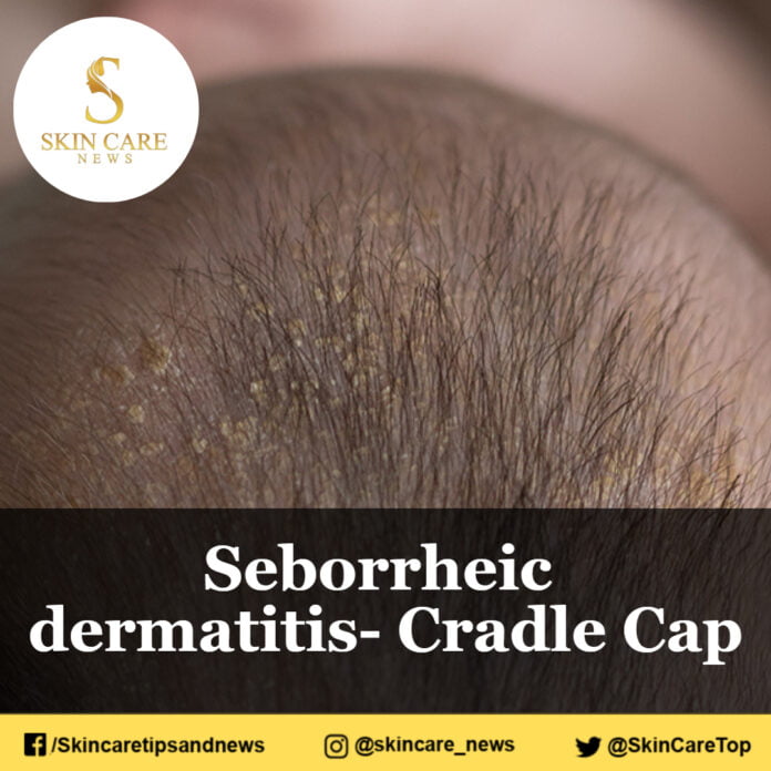Seborrheic dermatitis- Cradle Cap
