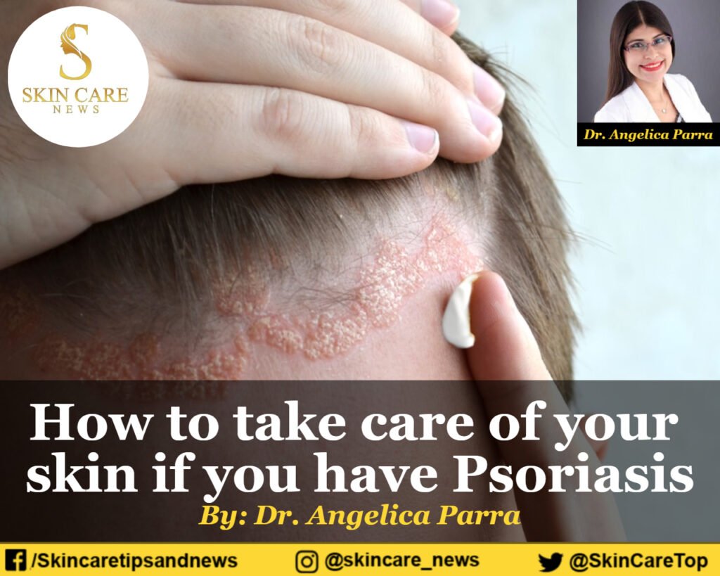 How to take care of your skin if you have Psoriasis