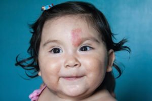 Things You Need to Know about Birthmarks