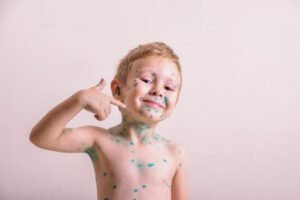 Chickenpox: How to Help Your Kid with the Itch
