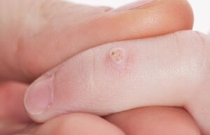Warts In Children –Prevention Tips