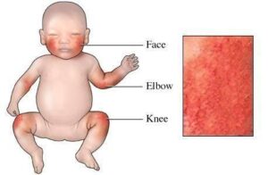 Atopic dermatitis kids