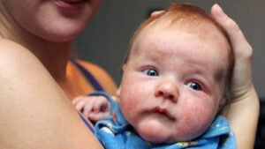 Atopic dermatitis kids