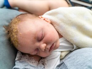 Seborrheic dermatitis- Cradle Cap