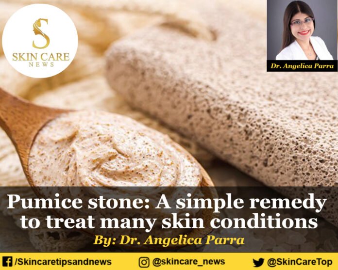 Pumice stone: A simple remedy to treat many skin conditions