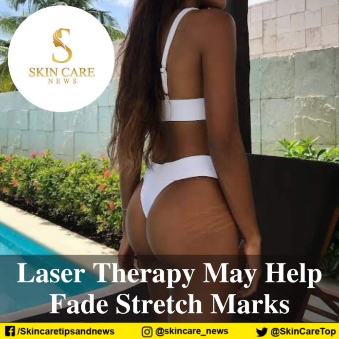 laser therapy may help fade stretch marks