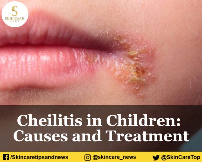 Cheilitis In Children: Causes And Treatment