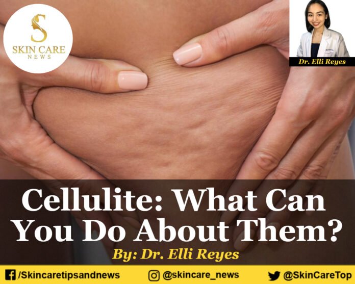 Cellulite: What Can You Do About Them?