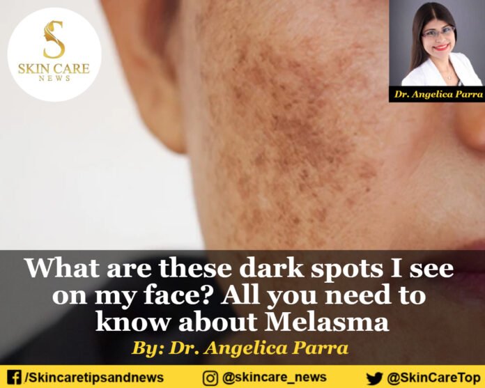 What are these dark spots I see on my face? All you need to know about Melasma
