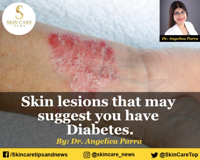 Skin lesions that may suggest you have Diabetes