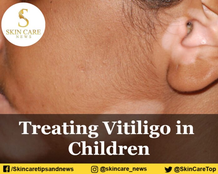 Treating Vitiligo in Children